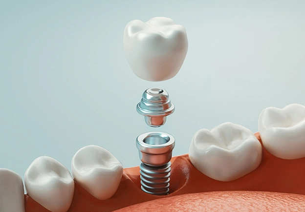 dental implants long beach ca