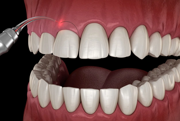 gum recontouring long beach ca