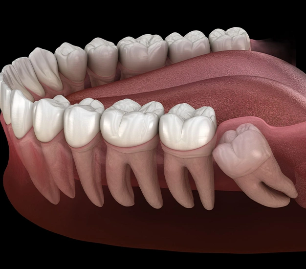 wisdom teeth removal long beach