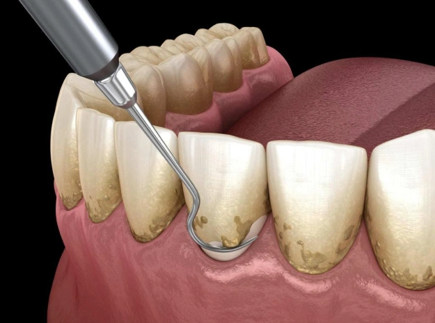 arestin treatment long beach ca