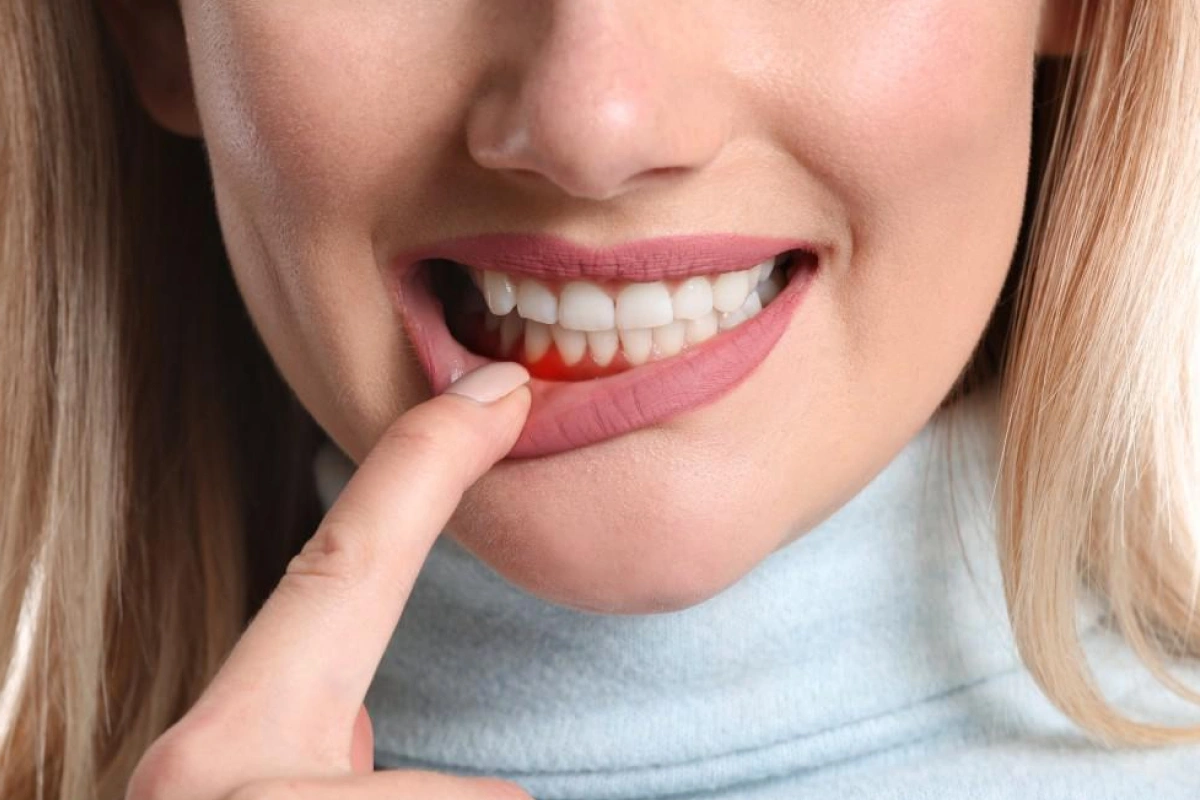 stages of periodontal disease