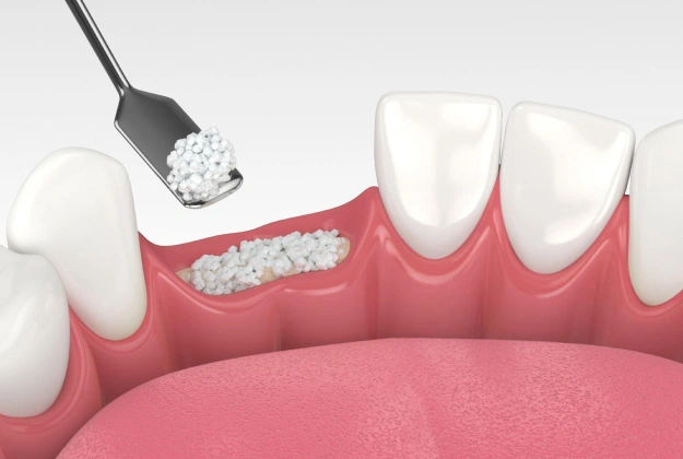 bone grafting long beach ca