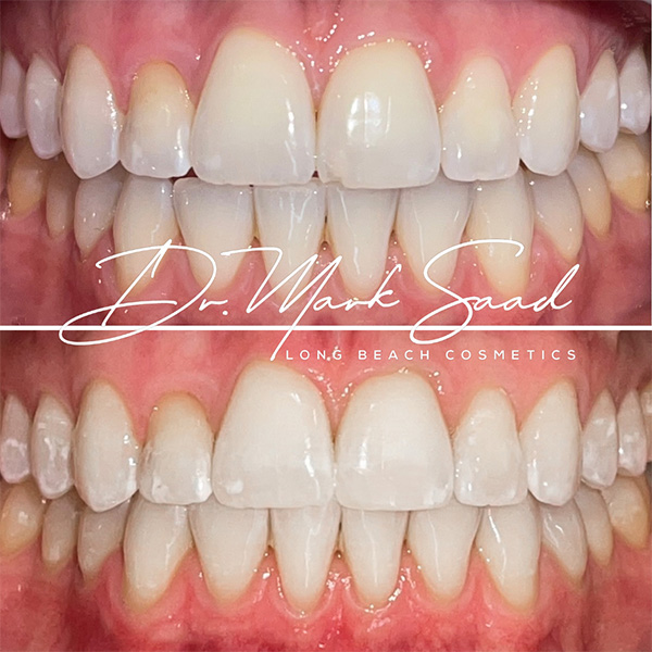 Teeth whitening transformation