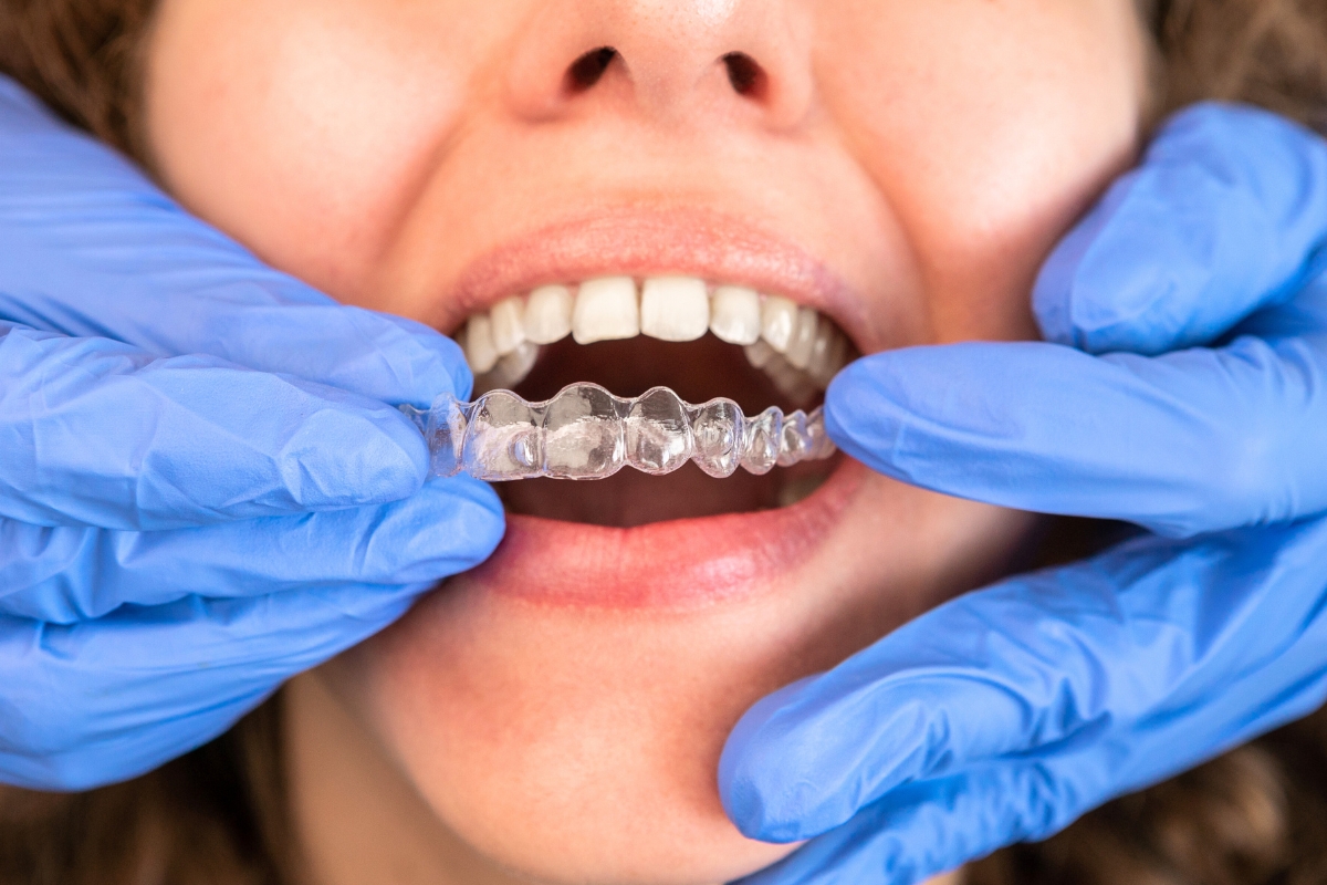 Can Invisalign Correct an Overbite