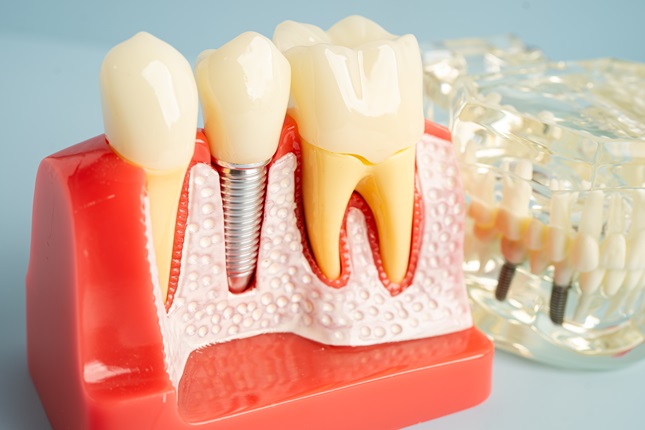 Do Dental Implants Restore Oral Function for Seniors?