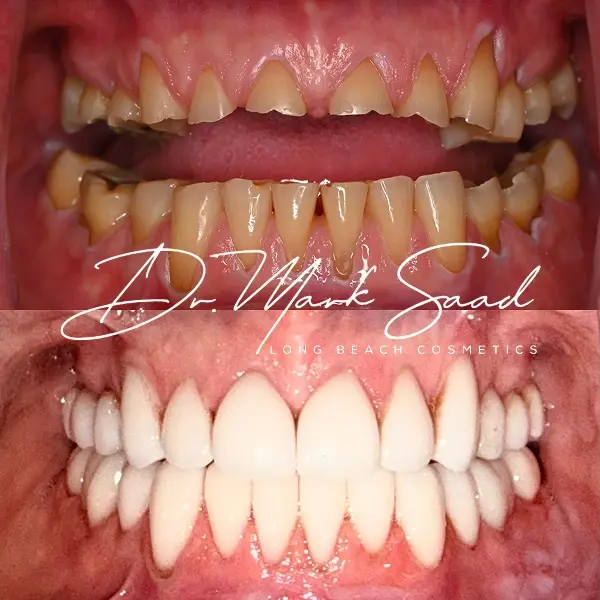 dental transformation with before-and-after results