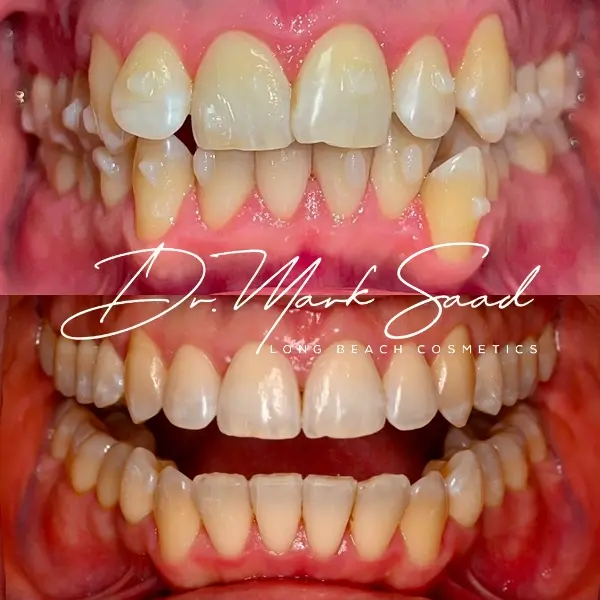 smile transformation before and after
