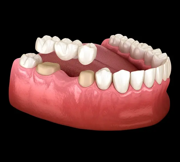 dental crowns and bridges
