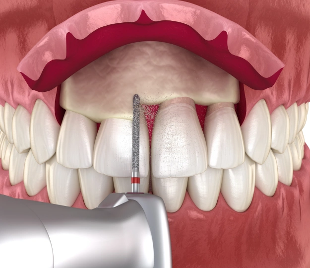 Illustration of crown lengthening