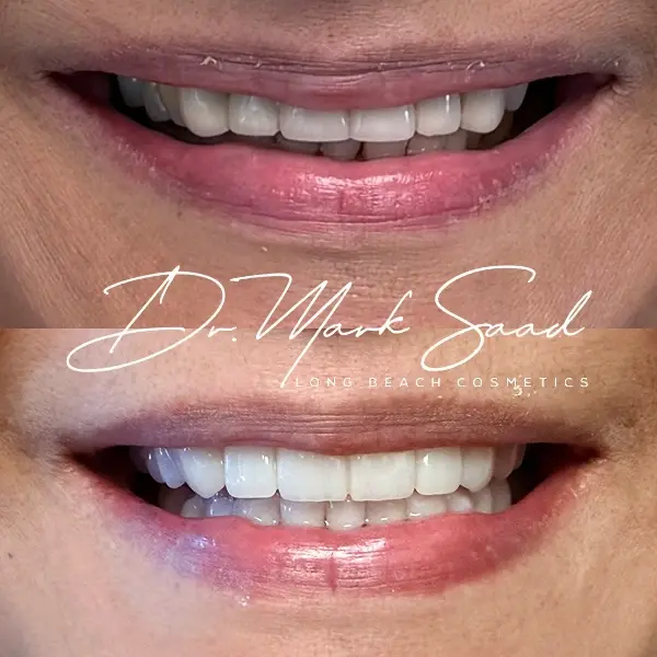 smile transformation