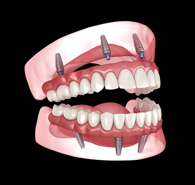 Illustration of full mouth rehabilitation