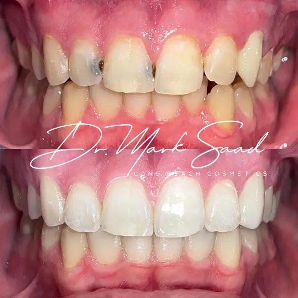 Smile makeover before and after