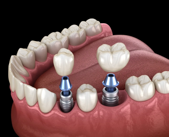 Illustration of implant crowns