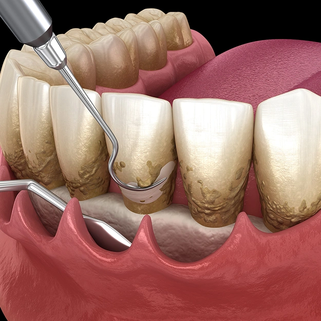 Illustration of osseous surgery