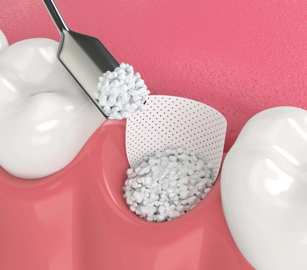 Illustration of ridge augmentation