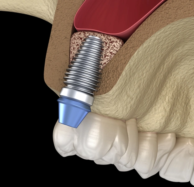 Illustration of sinus augmentation