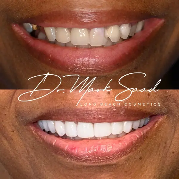 Before and after smile enhancement showing improved teeth whiteness and alignment in Long Beach.
