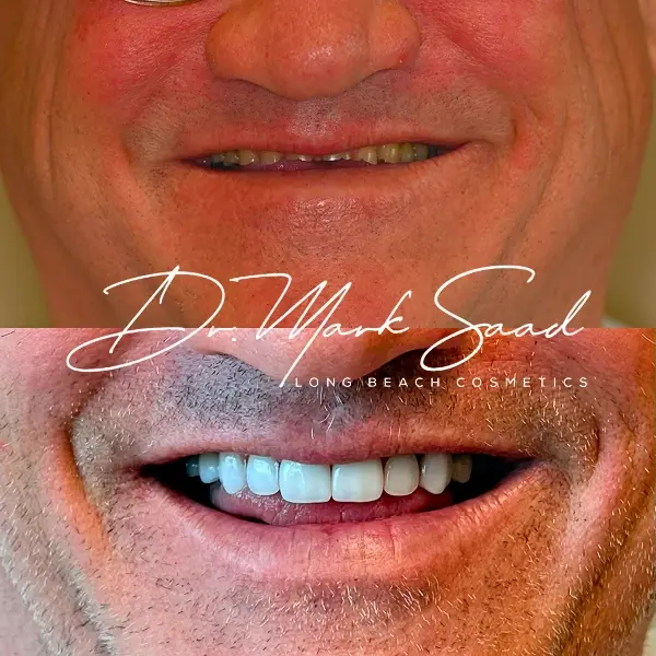D.Mark Saad smile reconstruction before and after results in Long Beach.
