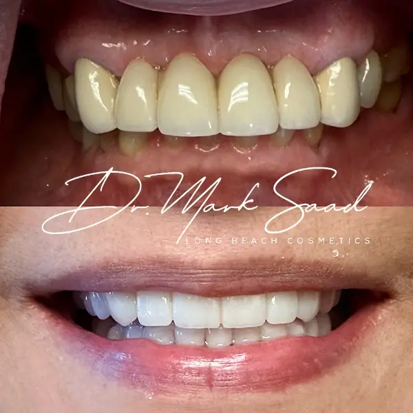 before and after dental work