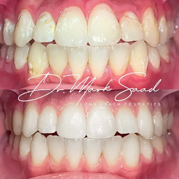 dental transformation result before after