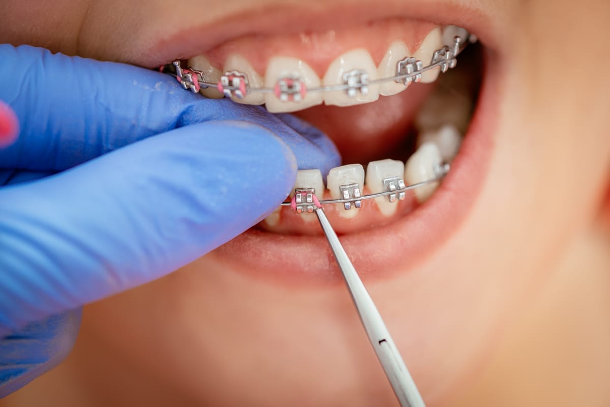 Dental Bridges in Long Beach